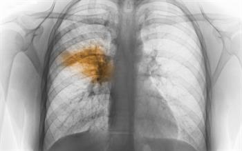 New antibiotic prescribing guidance issued for pneumonia