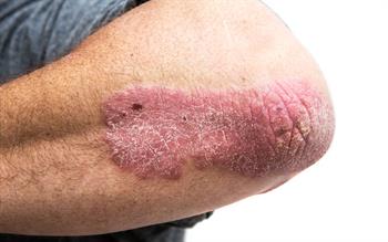 Elbow of a man with a raised red skin patch typical of psoriasis.