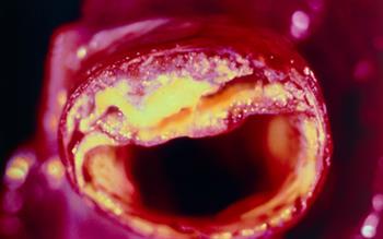 PCSK9 inhibitor licensed for risk reduction in established cardiovascular disease