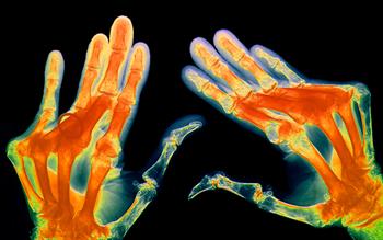 Arthritis treatment options widened with launch of anti-IL-6 antibody