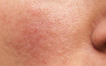 Cardiovascular warning for rosacea gel