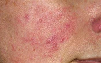 Start brimonidine gel at low dose in rosacea, cautions MHRA
