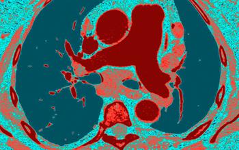 Selexipag: new class of treatment for pulmonary artery hypertension reaches prescribers