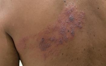 New shingles vaccine awaits decision on NHS use