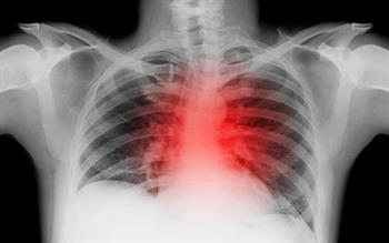 Chest X-ray with a visualisation of a heart attack as a glowing red area.
