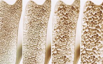 New vitamin D deficiency thresholds recommended