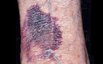 Warfarin interaction warning for miconazole oral gel