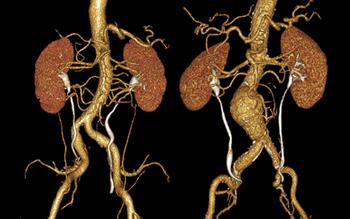 Quinolone warning over aortic aneurysm risk