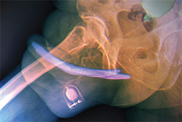 Erectile dysfunction - Clinical review