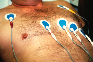 Managing stable angina in primary care