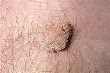 Cutaneous warts