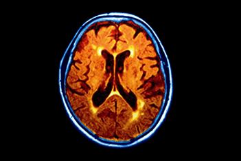 Journals Club - Antipsychotic prescribing for patients with dementia