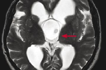 Evidence base: Narcolepsy