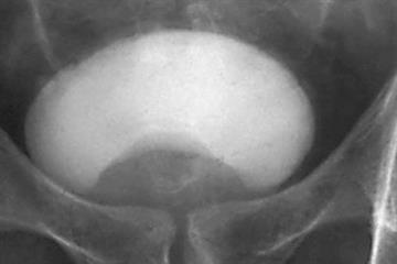 Lower urinary tract symptoms in men