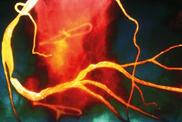 Lipid modification: NICE guideline