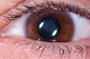 Blurred vision - Red flag symptoms