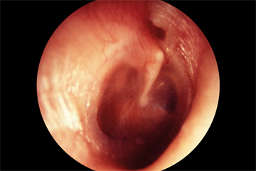 Acute otitis media in children