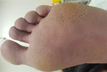 Pitted keratolysis resulting from hyperhidrosis case study