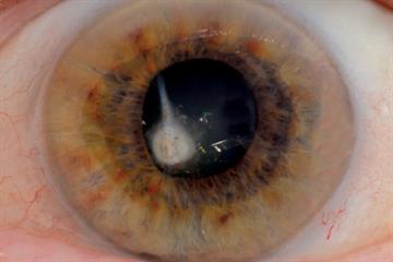 Clinical pictures: Eye problems