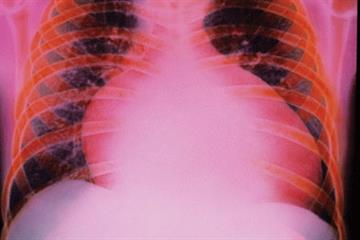 Evidence base: Heart failure