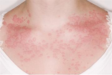 Patients at risk of anaphylaxis