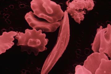 The basics - Sickle cell anaemia