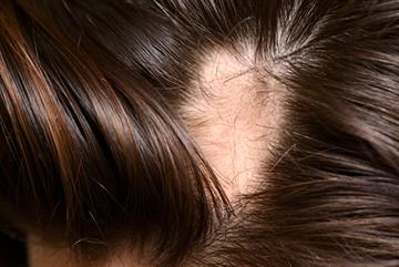 Hair loss - red flag symptoms