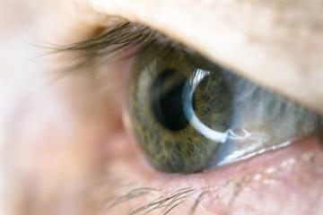 CKS Clinical solutions - Dry eye syndrome