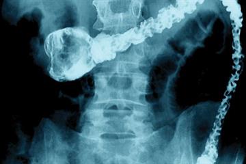 Diet and prevention of bowel cancer