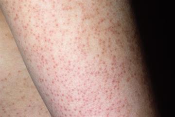 Troublesome rough skin