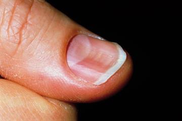 Haematology - Iron deficiency anaemia