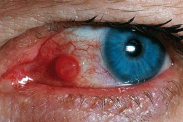 Pictorial case study: Swelling on the eye