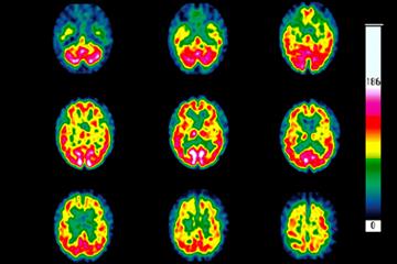 Evidence base: Huntington's disease