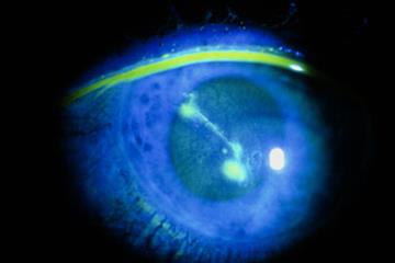 CKS Clinical Solutions - Superficial corneal injury