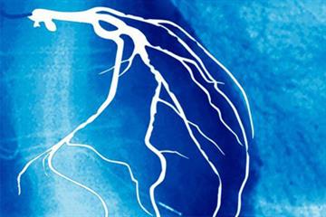 NICE guidelines - Treatment of stable angina