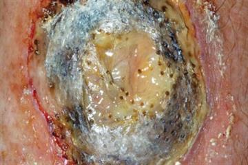 Pictorial case study: A painful ulcer