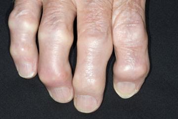 The basics - Osteoarthritis