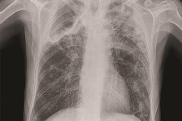 Evidence base: Pulmonary tuberculosis