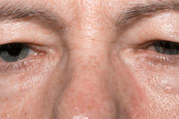 Case Study - An unusual case of unequal pupils