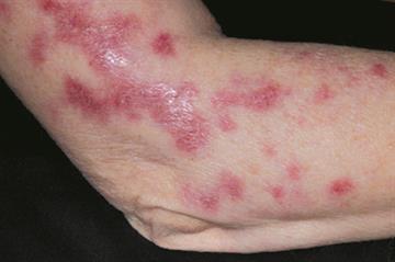 Clinical images: Bacterial infections