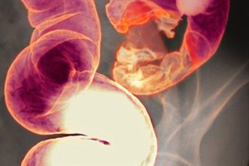 Red flag symptoms - Constipation