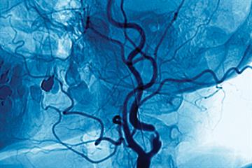 Clinical Review - Transient ischaemic attack