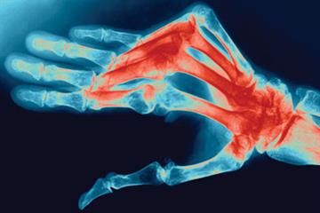 Smoking and rheumatoid arthritis
