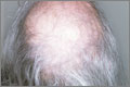 Treating female pattern baldness