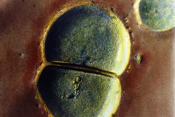 Case study: Genital swelling following caesarean delivery
