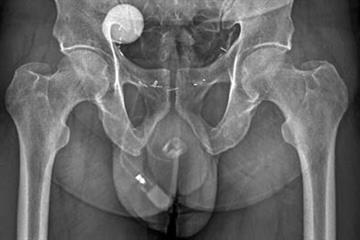 Urinary incontinence
