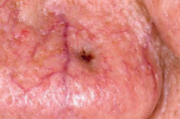 Pictorial case study - Basal cell carcinoma