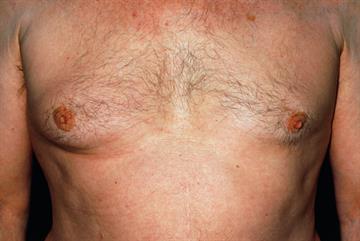 Male breast cancer case study