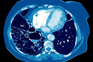 Bronchiectasis: clinical review