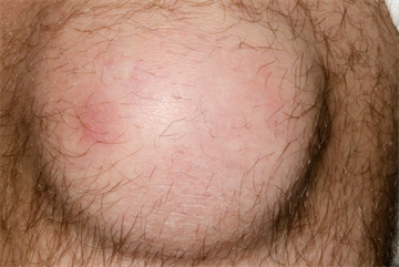 Pictorial case study - Prepatellar bursitis: presentation, management and discussion